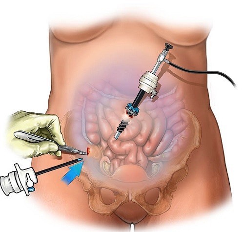 laparoscopy-inline-46cf03